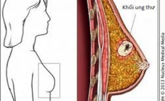 Chỉ đứng trước gương khi tắm, cô gái trẻ phát hiện ra bệnh ung thư