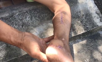 Làm rõ vụ bị trầy chân nhưng điều trị thành... 'què'